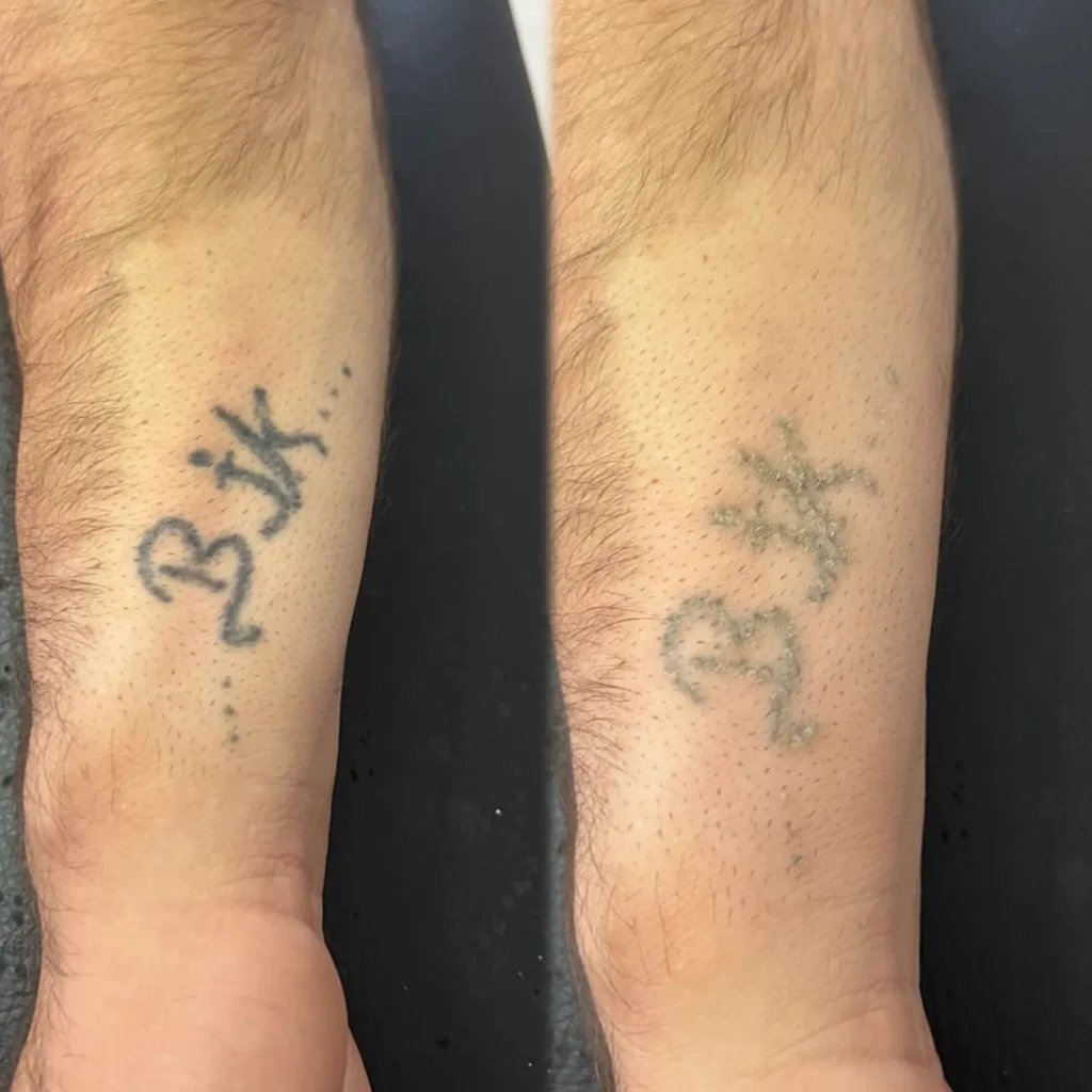 tattooed forearms showing fading tattoos