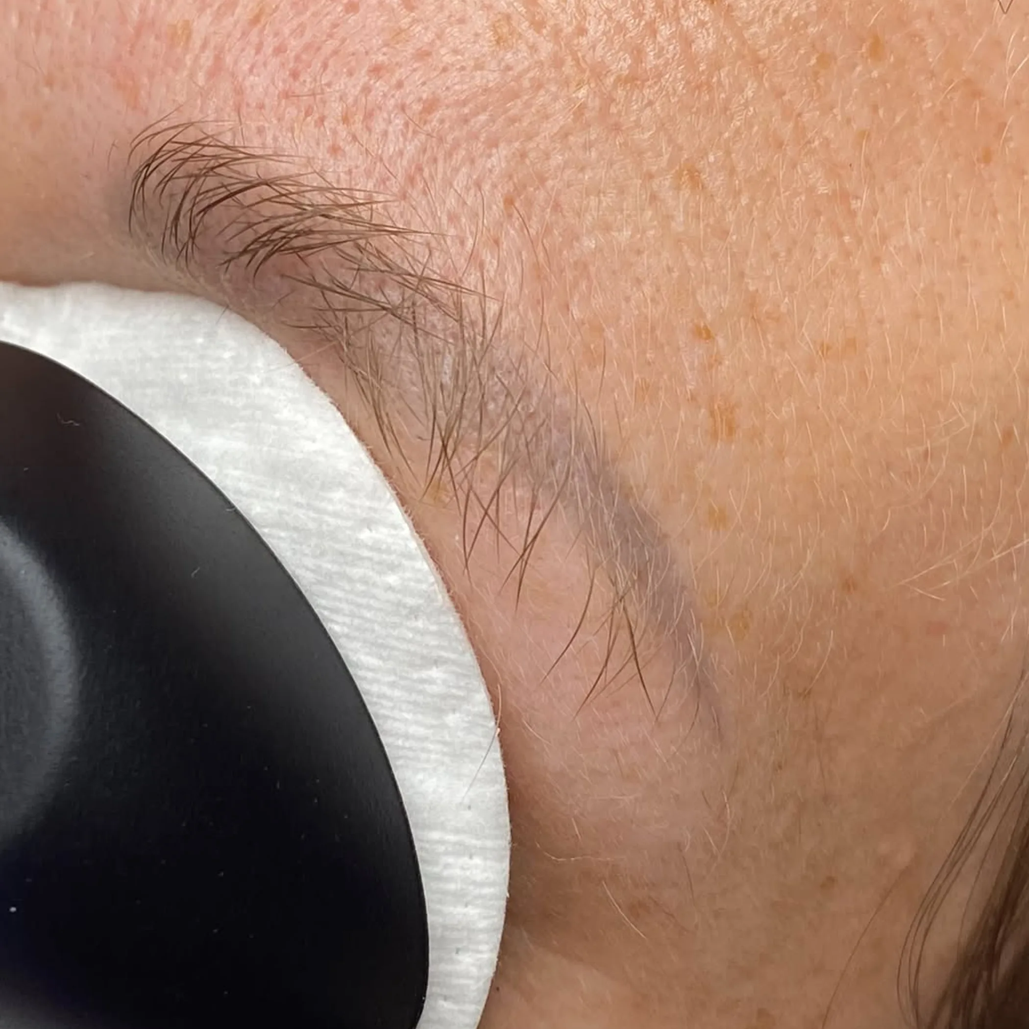 eyebrow tattoo removal in progress