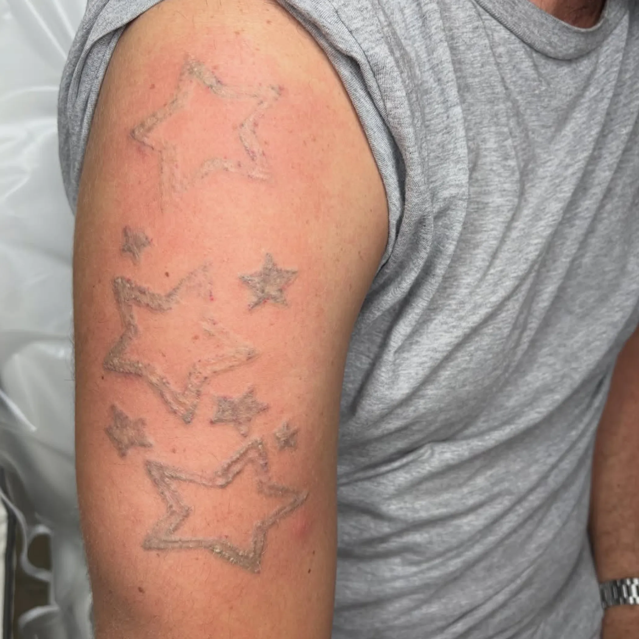 tattoo removal aftercare redness and fading tattoos