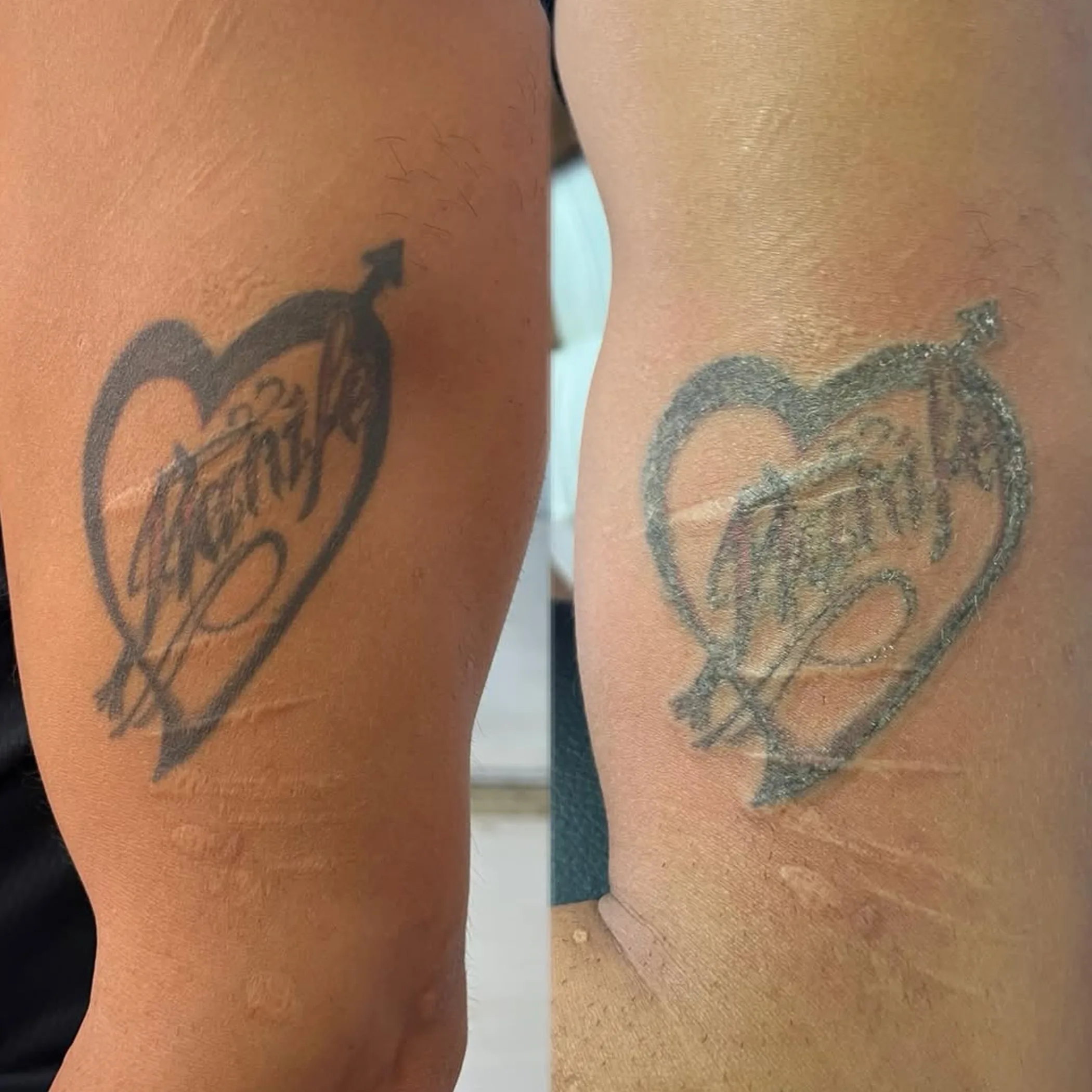 faded tattoo removal results